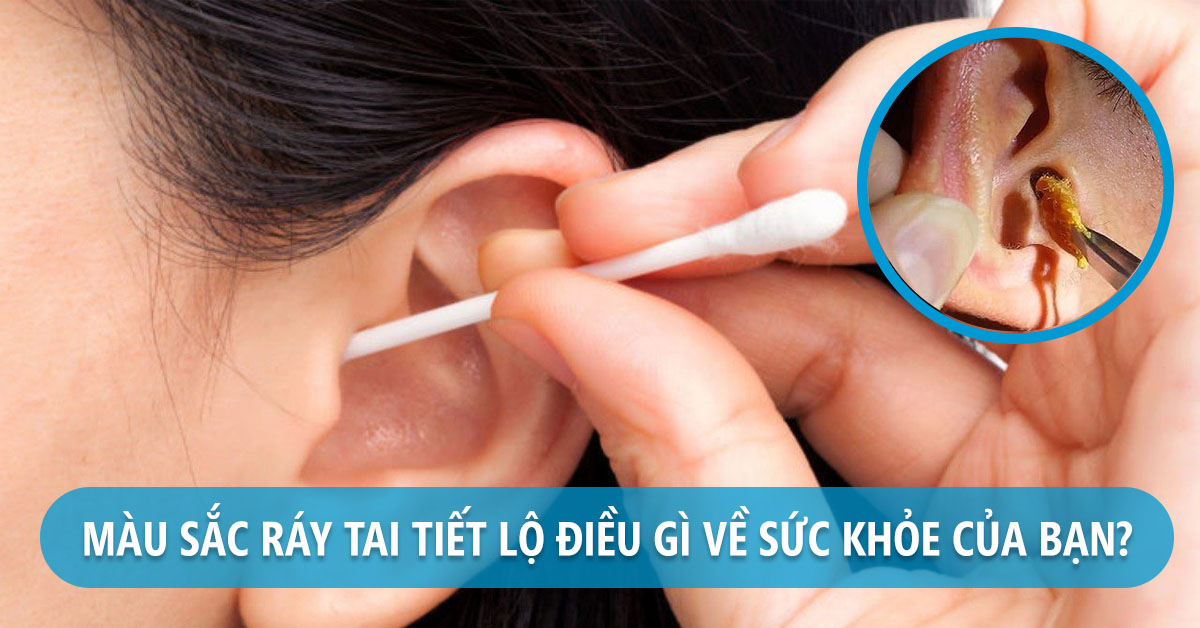 Ráy tai nhiều có ảnh hưởng gì không?