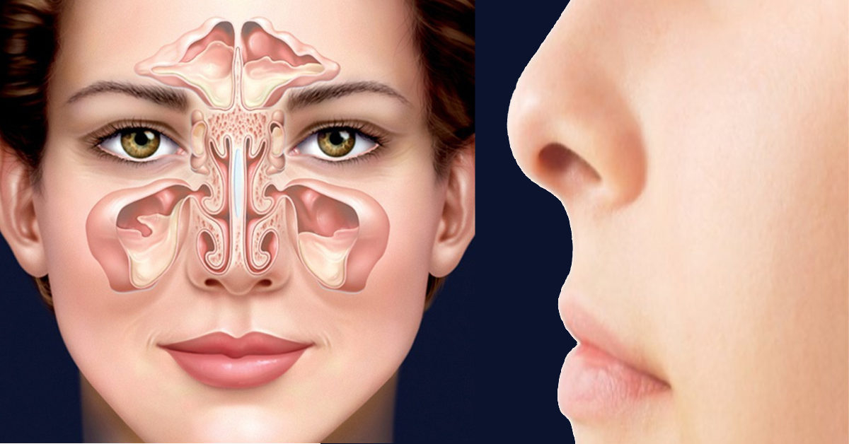 Viêm mũi là gì ? Những biểu hiện và cách chữa viêm mũi đơn giản.