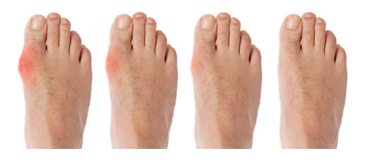 Máy chạy bộ giúp phòng chống bệnh gout như thế nào