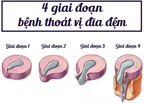 Ghế massage toàn thân cho người bị thoát vị đĩa đệm