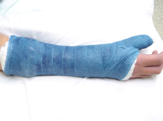 Phục hồi chức năng dành cho người gãy xương